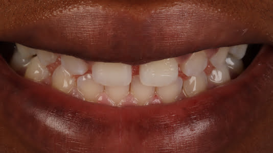 Composite bonding in London Ontario - Sbenati Dentistry