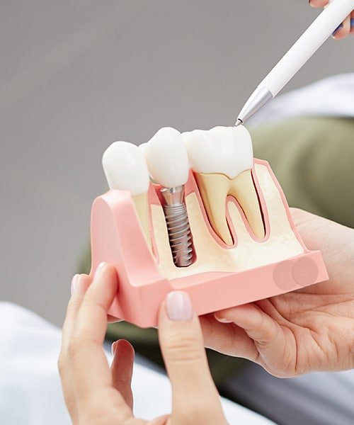 dental-implants-london-offer