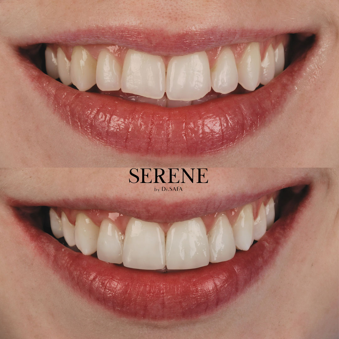 before-and-after-comp-1