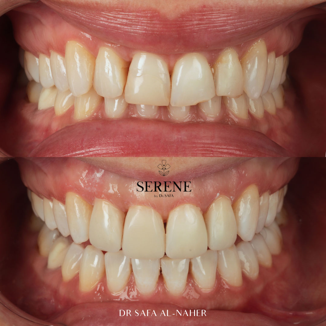 before-and-after-comp-2