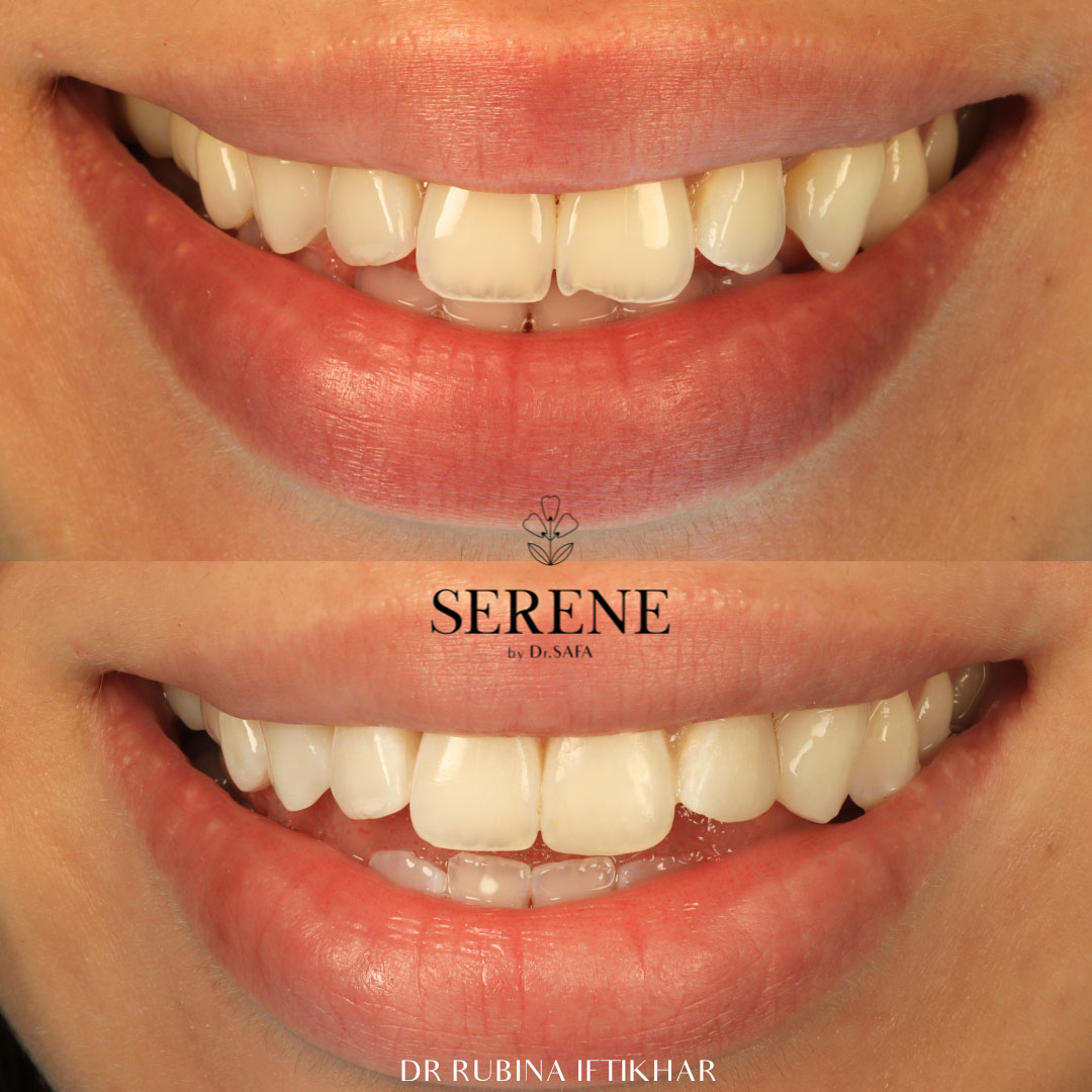 before-and-after-comp-3