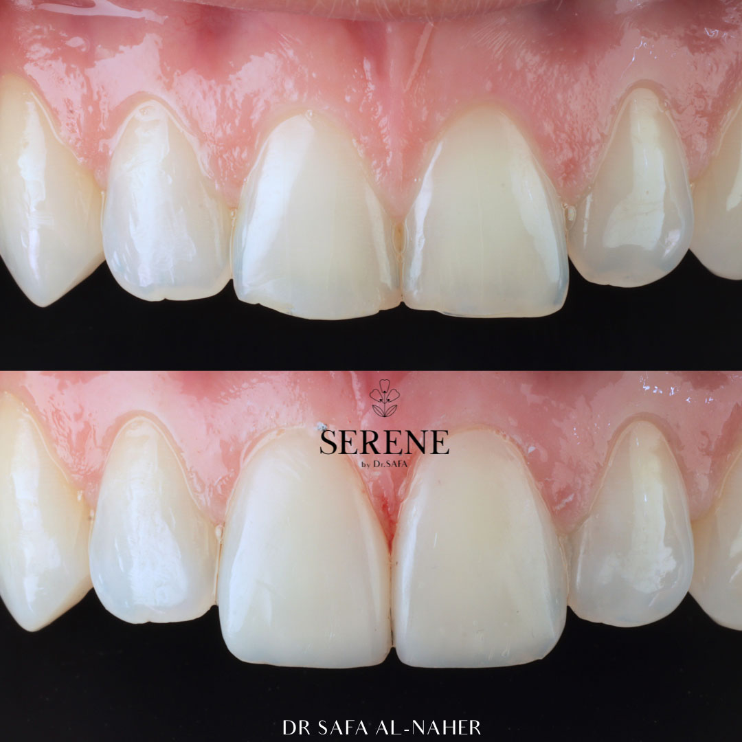 before-and-after-comp-4