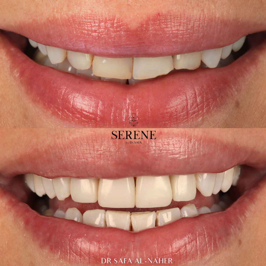 before-and-after-comp-5