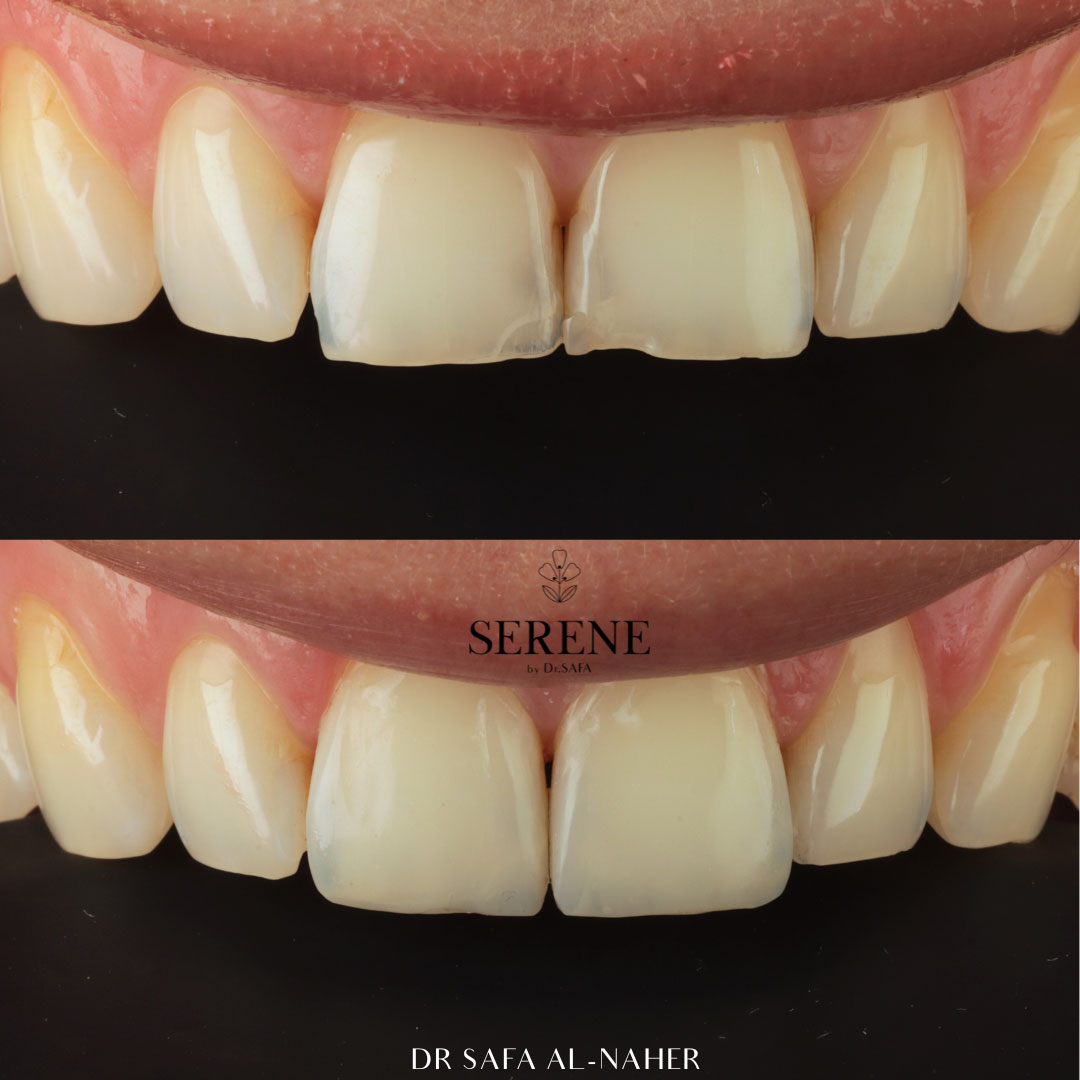 before-and-after-comp-7