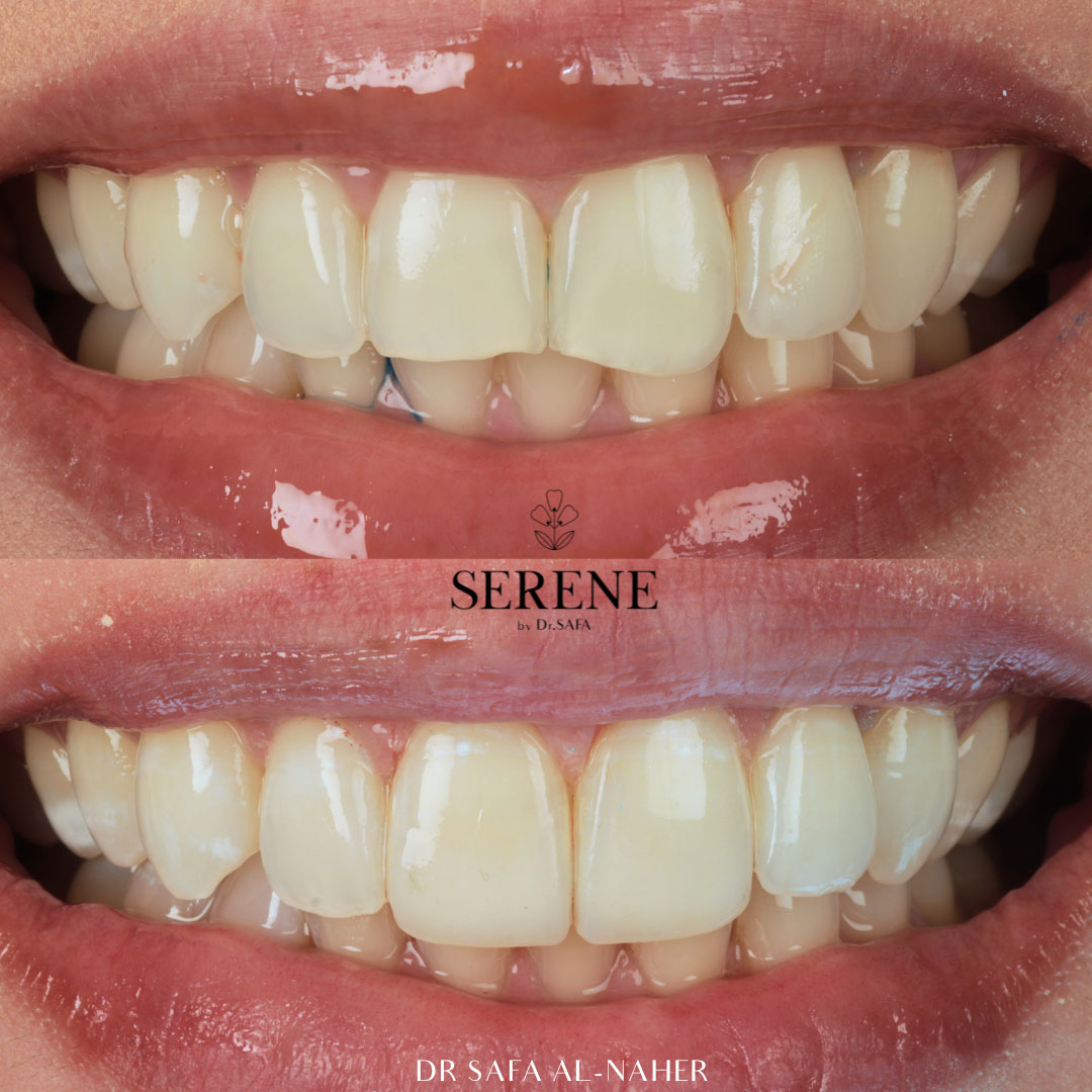 before-and-after-comp-9