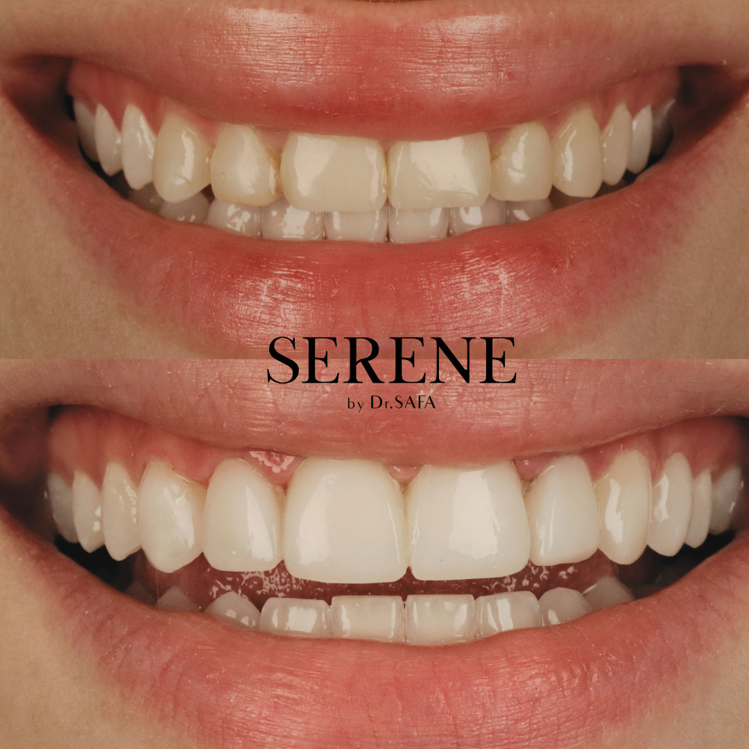 comp--and-whitening-before-and-after-(1)